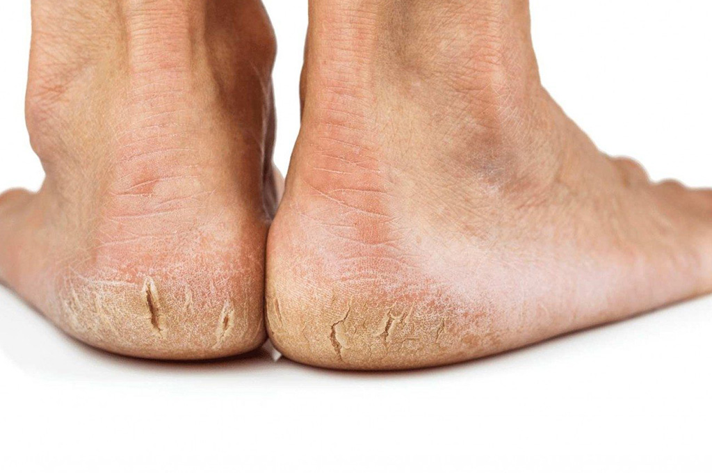 сухие стопы ног у женщин